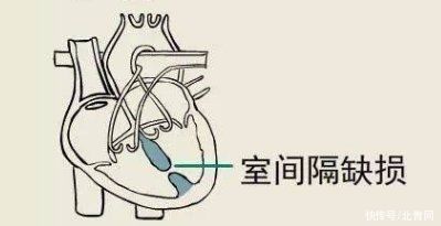 心室|罕见！台州32岁女子心脏有5个洞，怀孕体检时才发现，30多年前就有了