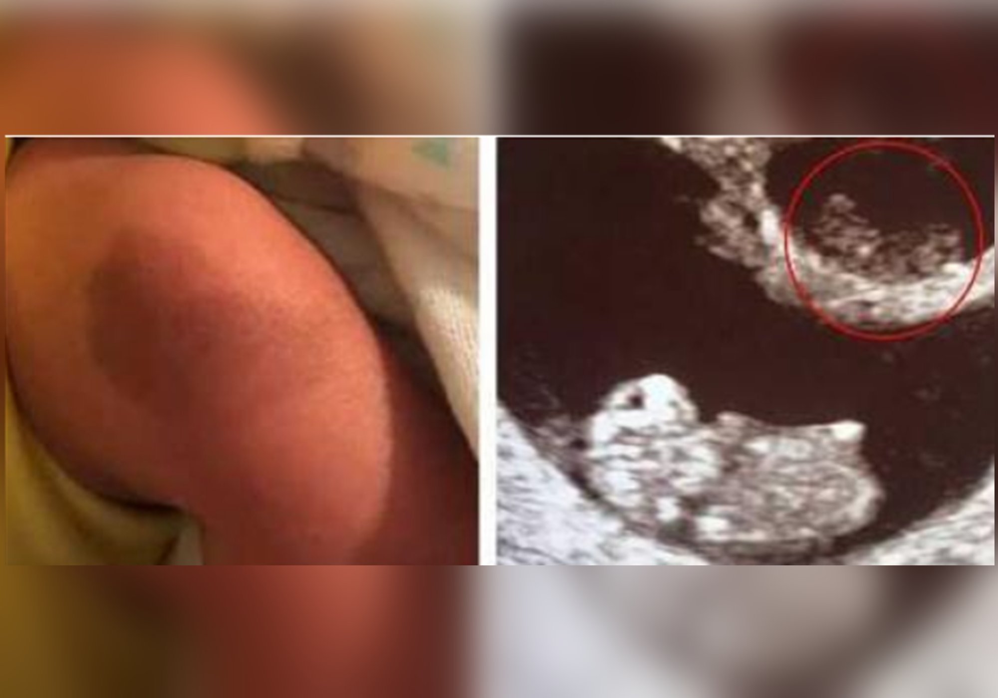 双胞胎|姐姐在腹中被弟弟“吸收”,化为胎记印在了弟弟腿上,爱的胎记