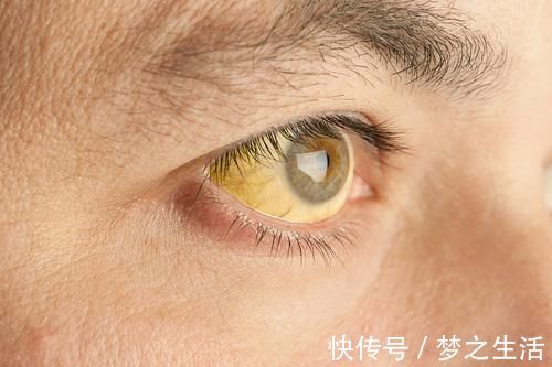 胆红素|头部有3个异常,暗示肝硬化,肝病最怕拖,出现一个也要尽早检查