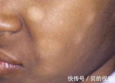 孩子|孩子脸上有白斑,要打虫吗?听听儿科医生怎么说