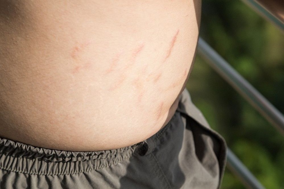 概率|怀孕就长妊娠纹？不一定，当孕妈符合以下条件，那就不容易长