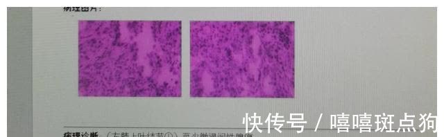 结节|磨玻璃肺癌都是高分化腺癌吗？磨玻璃结节发展到哪种腺癌都有可能