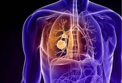 结节|肺结节恶化时 ,检查会有3个“异常”,若没有,恭喜你!肺还算健康