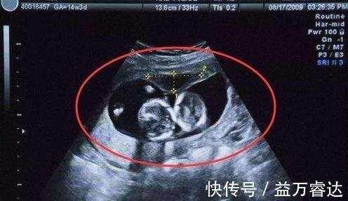 宝宝|孕24周B超检查,当看到宝宝的样子后,孕妈有些吓到了