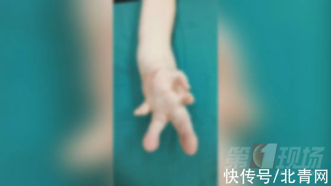 乐乐|双指粘连，12岁男孩手指比香蕉还粗！医生手术挽回手掌功能