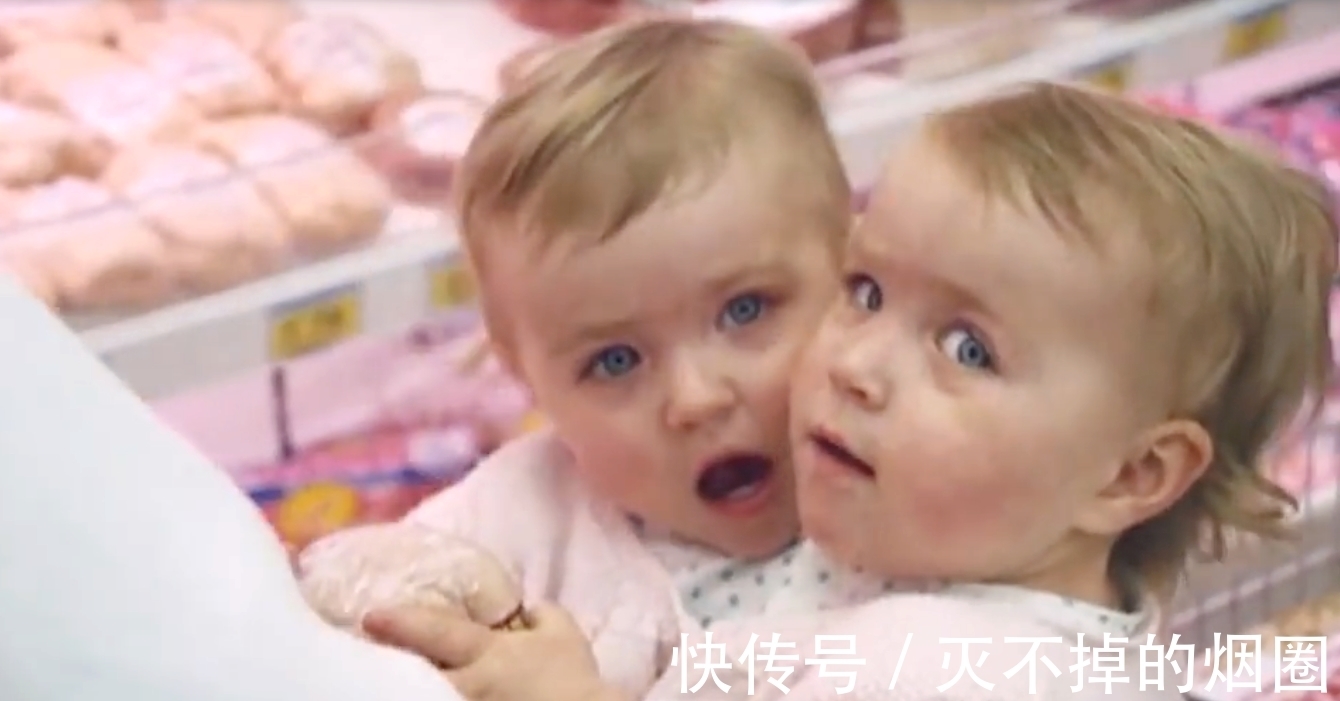 索菲亚|2女孩共用一个躯体生活3年,要将她们个体分离,能成功吗?