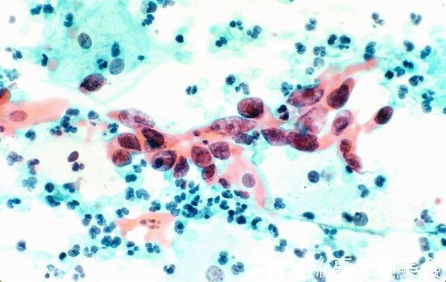 胆囊结石|胆囊切除有何后遗症？这3种“结局”不好受，除非万不得已，别切