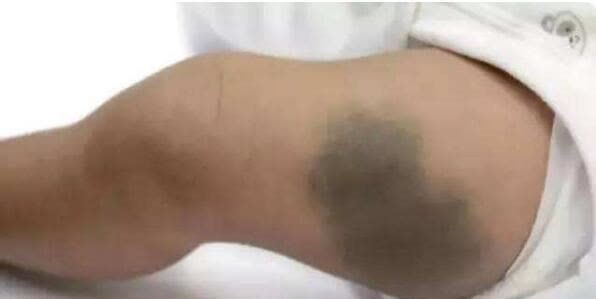 宝宝|宝宝的胎记怎么来的?产科医生:孕期这2种行为易长胎记,要避开