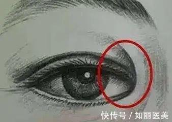 重睑 什么是割双眼皮呢?割双眼皮手术都包含哪些项目?你都了解吗