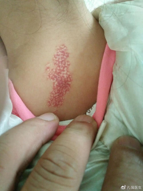 血管瘤为何提倡早治疗？