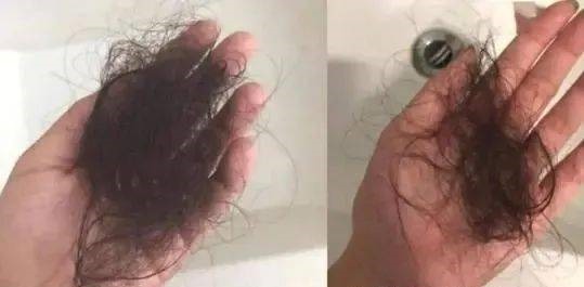 线头|2个月宝宝险被截肢,每小时放一次血!凶手竟是妈妈一根头发