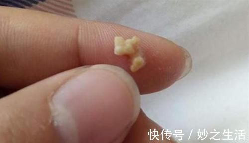 检查|“你嘴巴好臭”，孩子因嘴臭被欺负，送医检查后取出的颗粒确实臭