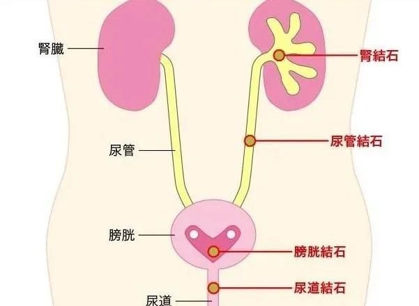 泌尿科医生给结石划了“疼痛等级”，长在这个位置的更危险