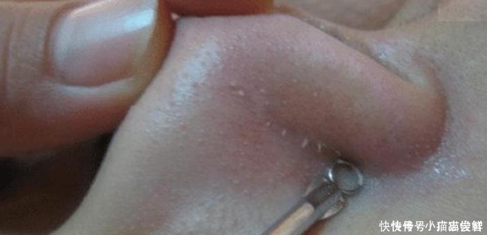 小疙瘩|抿紧下巴后突起的“白疙瘩”,千万要注意,这是螨虫的真身吗?