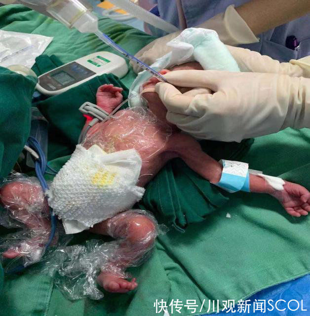 王俊英|体重最低时仅910克！崇州“巴掌宝宝”闯关75天后，如今快5斤啦