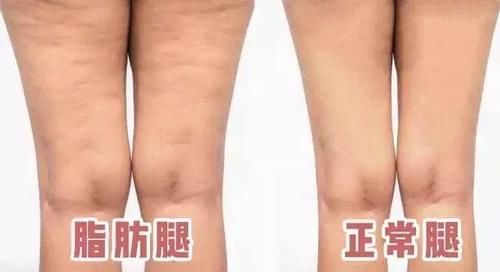  脂肪|想瘦腿，先看看你是哪种腿型