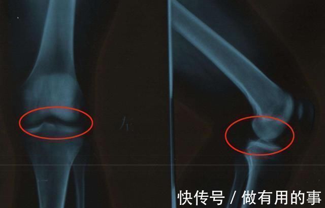 长高|13岁女孩身高停在128,医生诊断:都是爸妈的好习惯害得