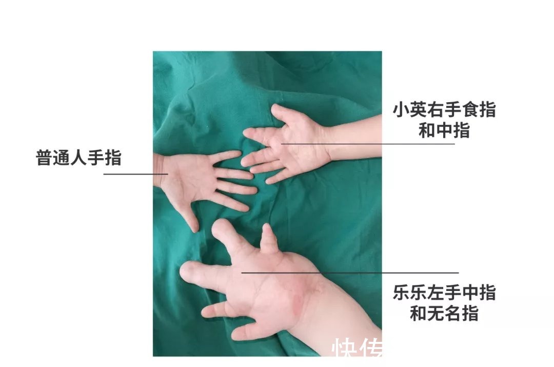 男孩|得了这病,12岁男孩手指比香蕉还粗!7种常见的手部畸形,家长们要注意