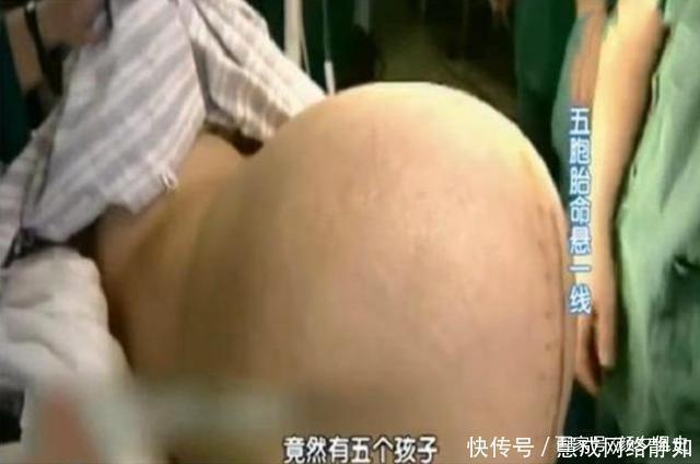 近况|当初35岁母亲产下全国第一例5胞胎,20年过去了,他们近况如何