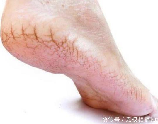 小知识|如果肾累了，脚上会有三个“东西”，如果发现一个，该照顾肾脏了