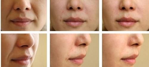 脸上有法令纹，填充玻尿酸还是做线雕？听听医生怎么说