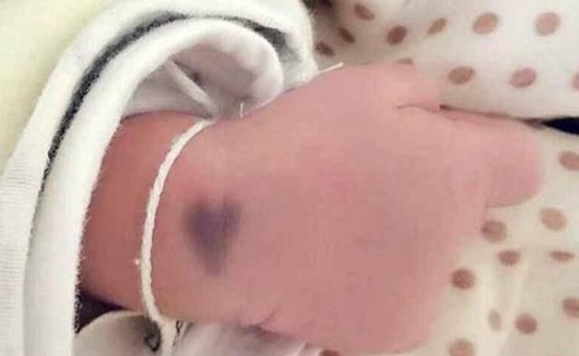 屁股|宝宝身上有淤青是来给父母报恩的如果胎记长成这样,家长要重视