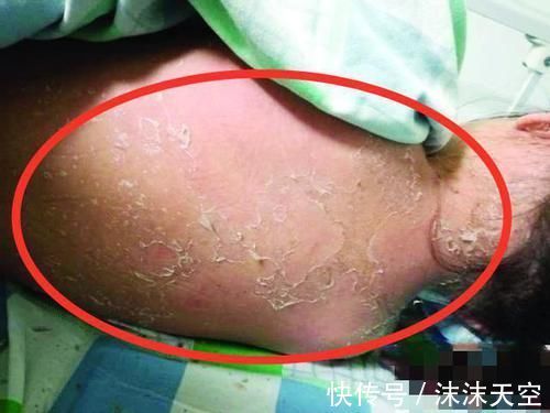 泳池|全家出门游泳,6岁女儿回来后皮肤大片脱落,医生的话令家长崩溃