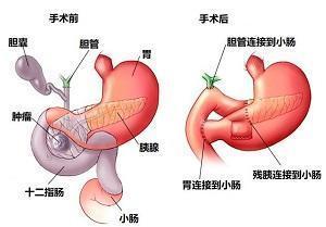 腹痛|胰腺癌出现,身体常发4个警示信号!发现了就是幸事,一秒别拖