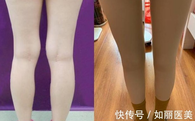 大长腿 大腿吸脂的价格多少钱？内附术后对比图日记~