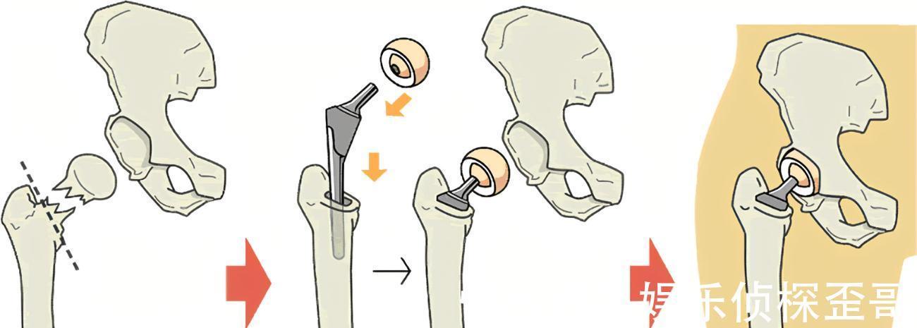 关节炎|晚期关节炎能靠人工关节置换术夺回健康？医生讲明不早用的理由