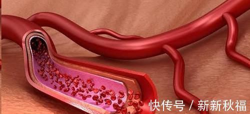 胆固醇|6味中药,传承了500年,开水一烫,血液不再粘稠,血脂血栓全溶光