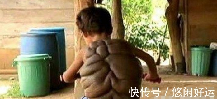 龟壳|奇闻：男孩背上长龟壳，父亲要扔掉，治疗后成这个模样
