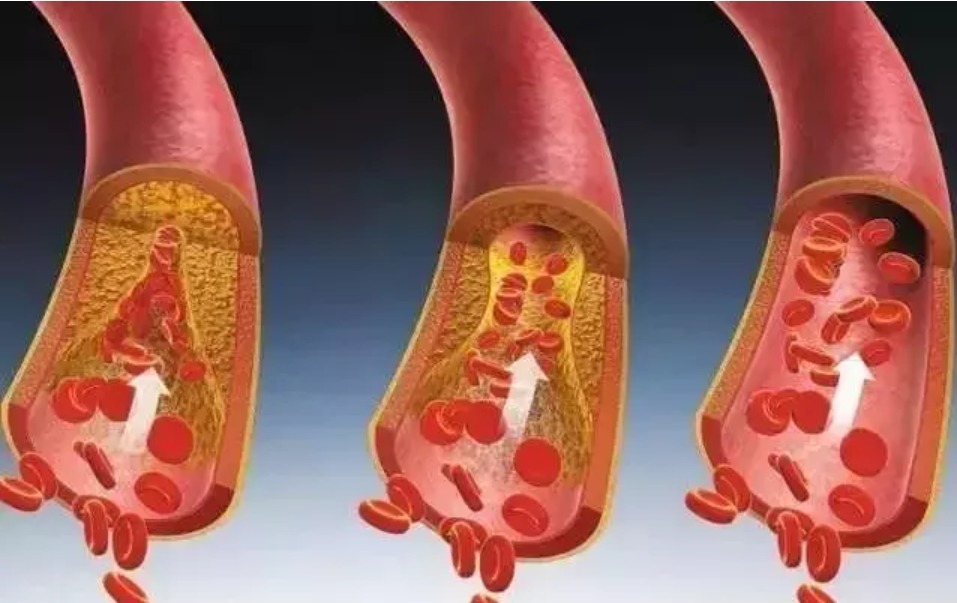 保护血管|血管洗个澡，健康活到老！每天洗1次，血管干净，99岁都不老！
