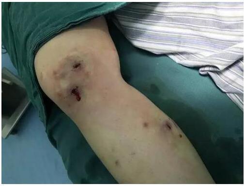 虫子|90后女大学生全身长满虫子,疼痛难忍送医时,医生却破口大骂