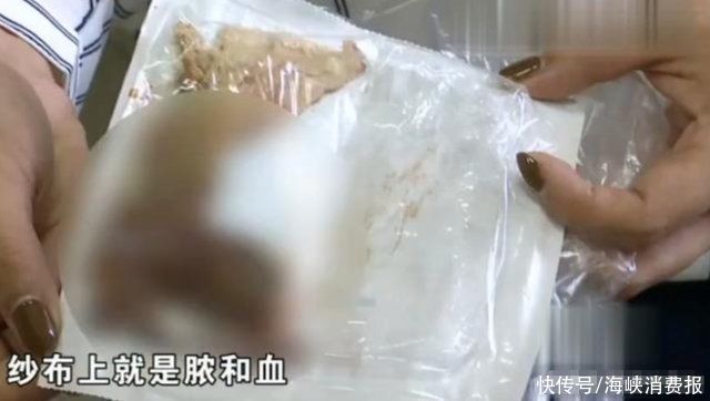  肛瘘|男子做肛瘘手术一个月，从伤口扯出一块纱布，手术完忘记取出来?