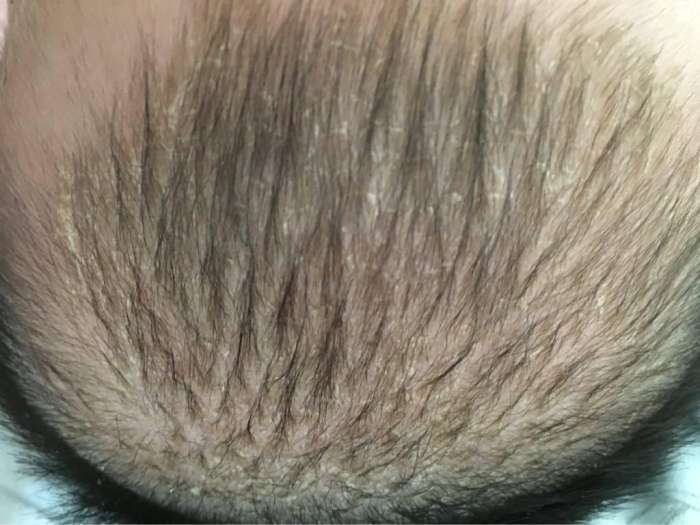 宝宝|刚满月的宝宝就高烧不退!医生看到宝宝的头皮后怒斥她不配做妈妈