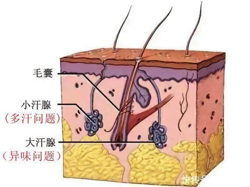 遗传性狐臭
