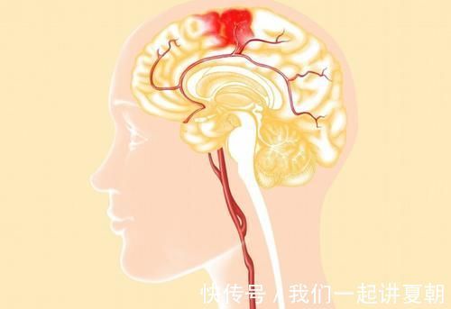 血管疾病|33岁女子,跳广场舞突然晕倒,脑溢血离世,医生惋惜:2件事要了她的命!