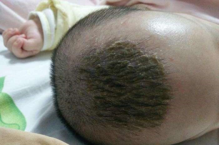 小丽|刚满月的宝宝就高烧不退!医生看到宝宝的头皮后怒斥她不配做妈妈