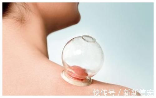负压|拔罐真的能排毒吗,拔完后的淤血到底是什么?医生终于道出真相