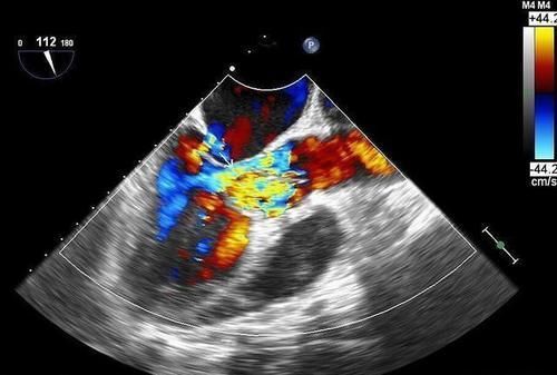 先天性心脏病|心脏彩超能检查出什么病来？心血管医生：这几种心脏病都可以