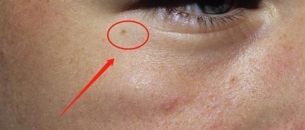 眼角膜|血脂高不高,看脸便知晓?脸上出现4大表现,要注意降低血脂了