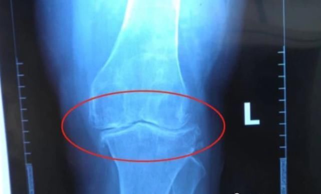 骨骼|男生多少岁会“停止长高”?不是18,也不是22,而是这个年纪