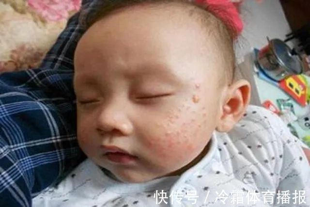 新生儿|宝宝湿疹反复太难缠,妈妈好心疼,对付宝宝湿疹弄懂这些很有必要