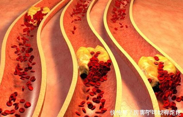 吃醋能软化血管?听听医生怎么说,看完或许就懂了