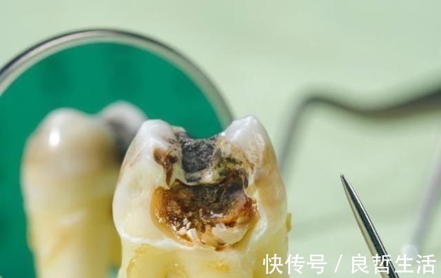 刷牙|10个5岁儿童中,7个有龋齿,罪魁祸首居然不是糖?