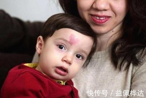 孕期|胎记是怎么来的?产科大夫:天生的除外,孕期这3种行为尽量避开