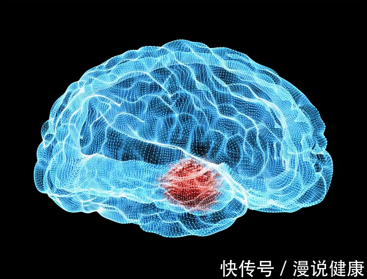 血管|脑梗也是吃出来?这3种食物太伤血管,排在第一不少人都爱吃