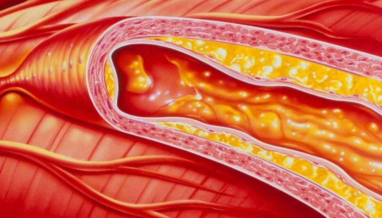 慢性疾病|4种人最容易被高血脂盯上！若你是其中一员，务必尽早重视