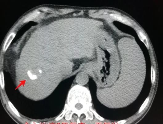 癌症患者体重增加，是好现象吧？